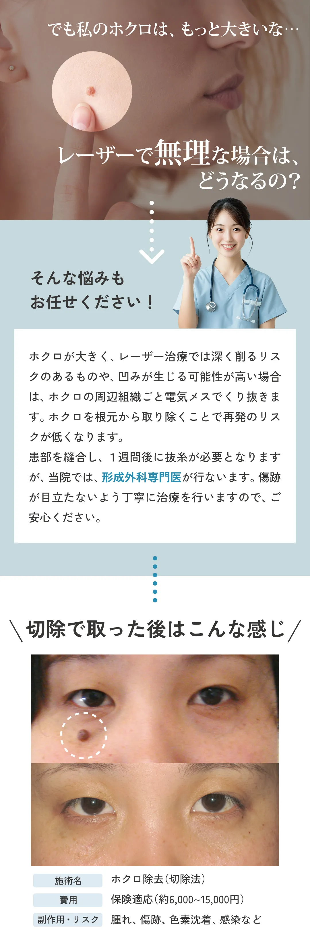 でも私のホクロはもっと大きいな・・・レーザーで無理な場合どうなるの?